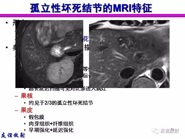 【PPT】基本病变的MRI信号分析：水肿、坏死、纤维化