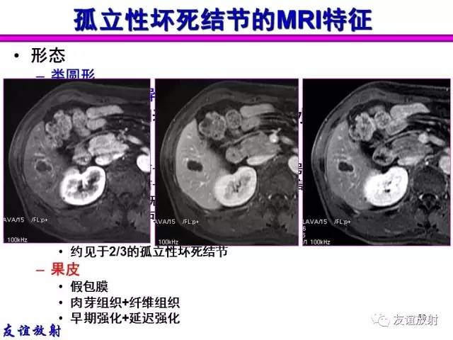 【PPT】基本病变的MRI信号分析：水肿、坏死、纤维化