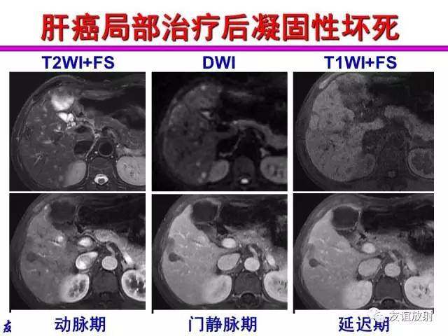 【PPT】基本病变的MRI信号分析：水肿、坏死、纤维化