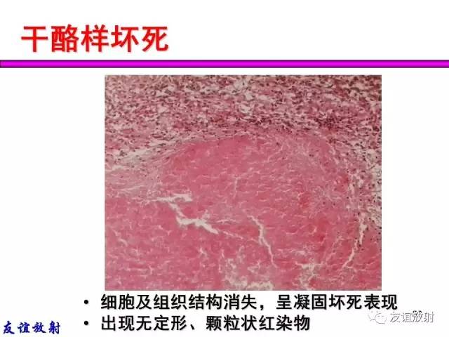 【PPT】基本病变的MRI信号分析：水肿、坏死、纤维化