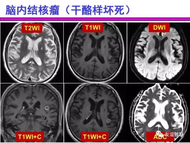 【PPT】基本病变的MRI信号分析：水肿、坏死、纤维化