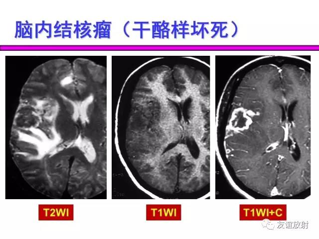 【PPT】基本病变的MRI信号分析：水肿、坏死、纤维化