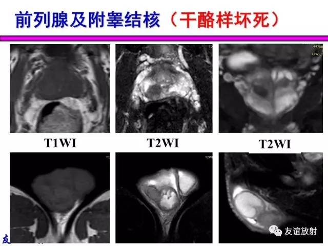 【PPT】基本病变的MRI信号分析：水肿、坏死、纤维化