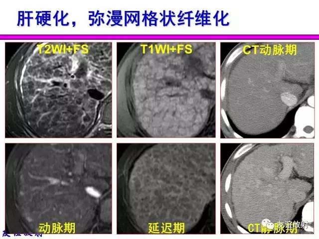 【PPT】基本病变的MRI信号分析：水肿、坏死、纤维化