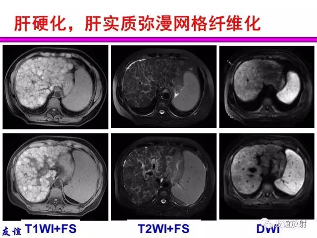 【PPT】基本病变的MRI信号分析：水肿、坏死、纤维化