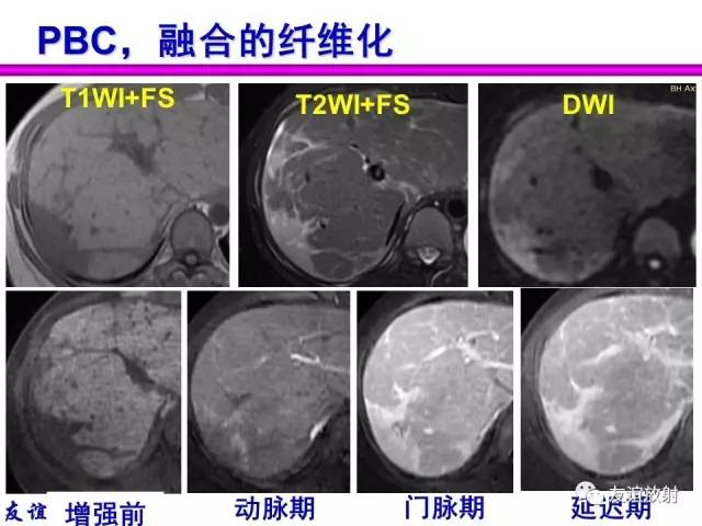 【PPT】基本病变的MRI信号分析：水肿、坏死、纤维化