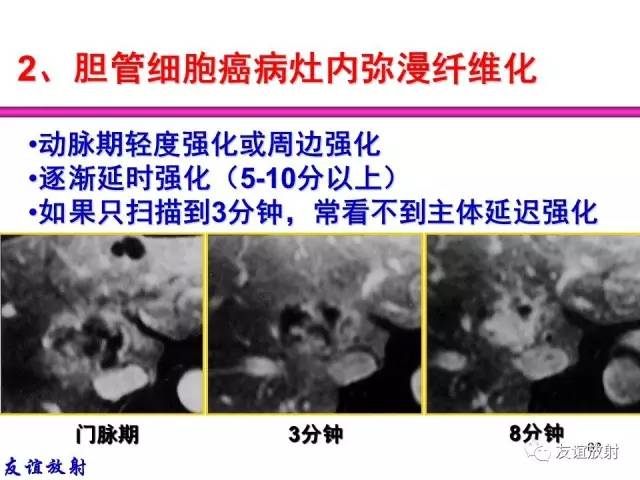 【PPT】基本病变的MRI信号分析：水肿、坏死、纤维化