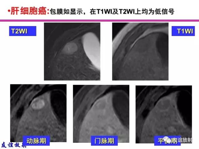 【PPT】基本病变的MRI信号分析：水肿、坏死、纤维化