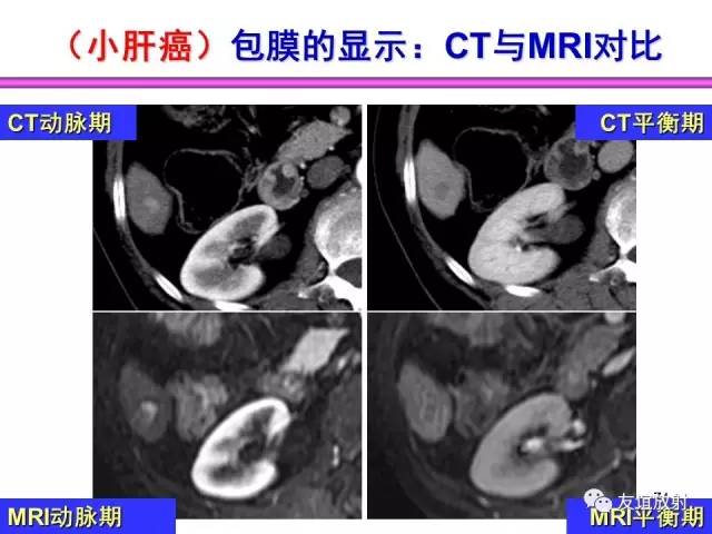 【PPT】基本病变的MRI信号分析：水肿、坏死、纤维化