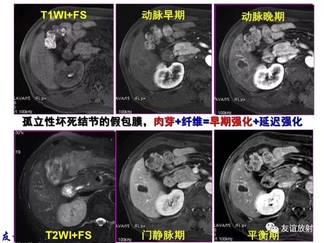 【PPT】基本病变的MRI信号分析：水肿、坏死、纤维化