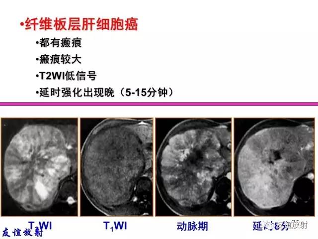 【PPT】基本病变的MRI信号分析：水肿、坏死、纤维化