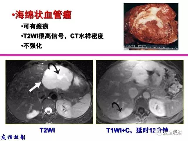 【PPT】基本病变的MRI信号分析：水肿、坏死、纤维化