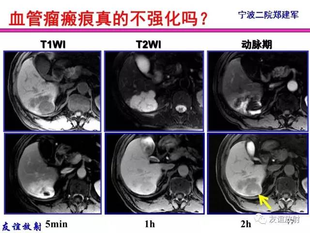 【PPT】基本病变的MRI信号分析：水肿、坏死、纤维化
