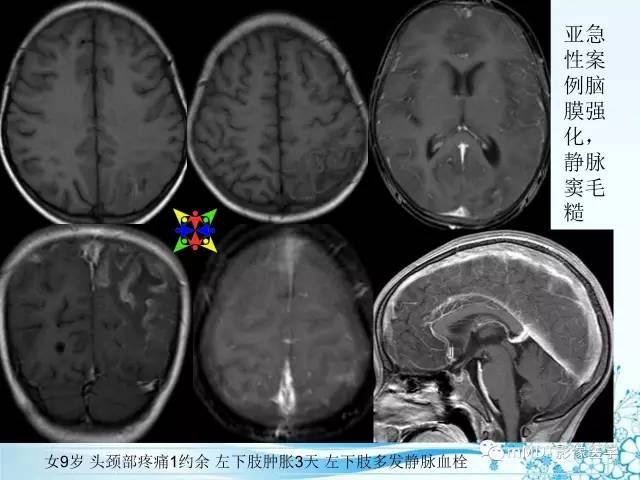 【PPT】脑静脉及静脉窦血栓影像诊断