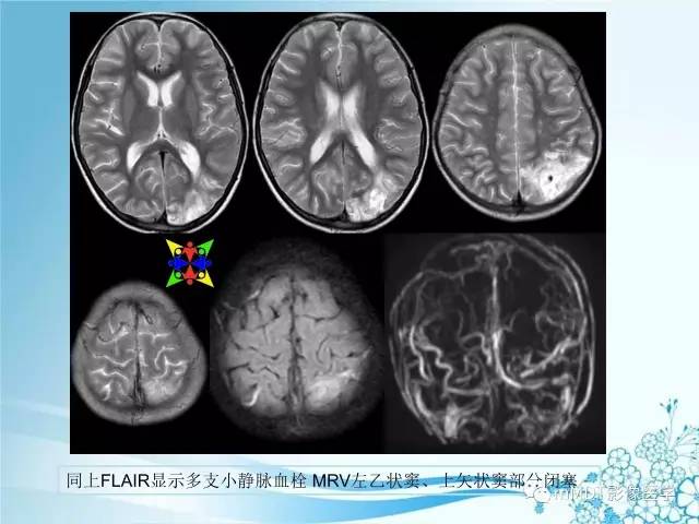【PPT】脑静脉及静脉窦血栓影像诊断