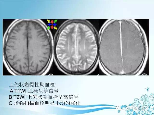 【PPT】脑静脉及静脉窦血栓影像诊断
