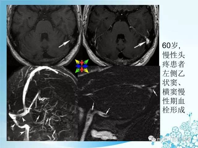 【PPT】脑静脉及静脉窦血栓影像诊断