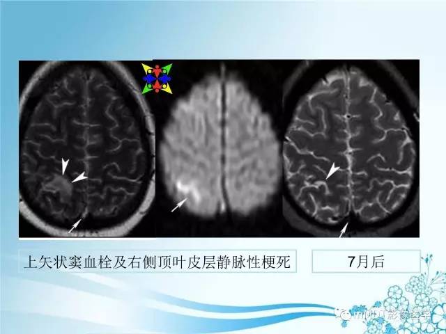 【PPT】脑静脉及静脉窦血栓影像诊断