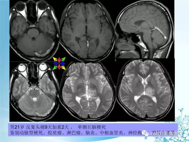 【PPT】脑静脉及静脉窦血栓影像诊断