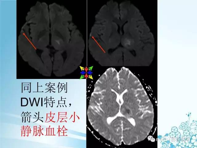 【PPT】脑静脉及静脉窦血栓影像诊断