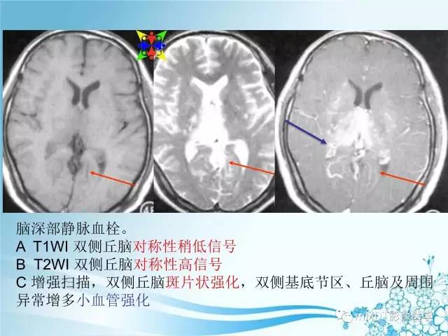 【PPT】脑静脉及静脉窦血栓影像诊断