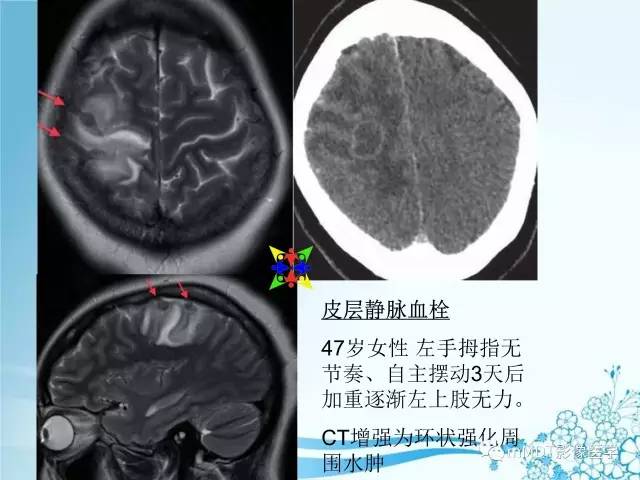 【PPT】脑静脉及静脉窦血栓影像诊断