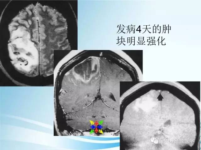 【PPT】脑静脉及静脉窦血栓影像诊断