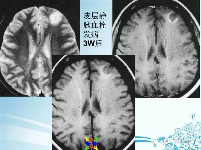 【PPT】脑静脉及静脉窦血栓影像诊断