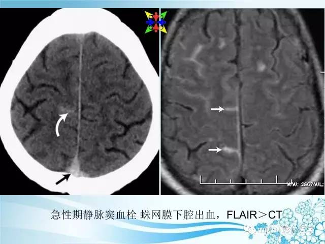 【PPT】脑静脉及静脉窦血栓影像诊断
