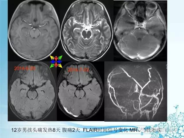 【PPT】脑静脉及静脉窦血栓影像诊断