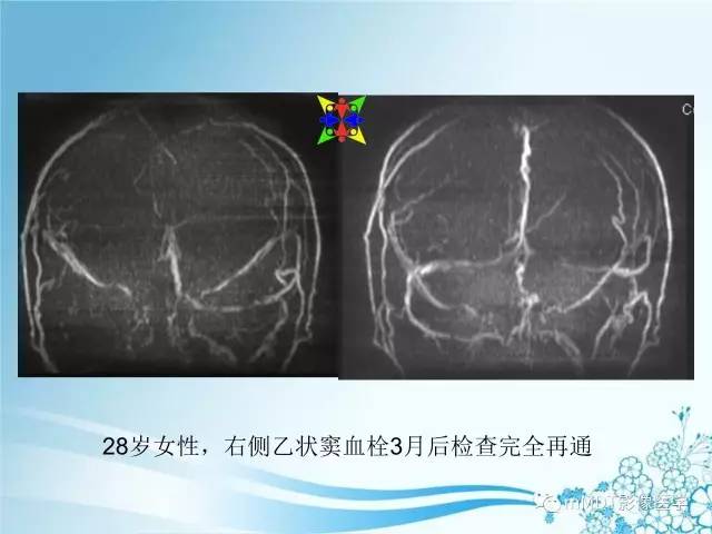 【PPT】脑静脉及静脉窦血栓影像诊断