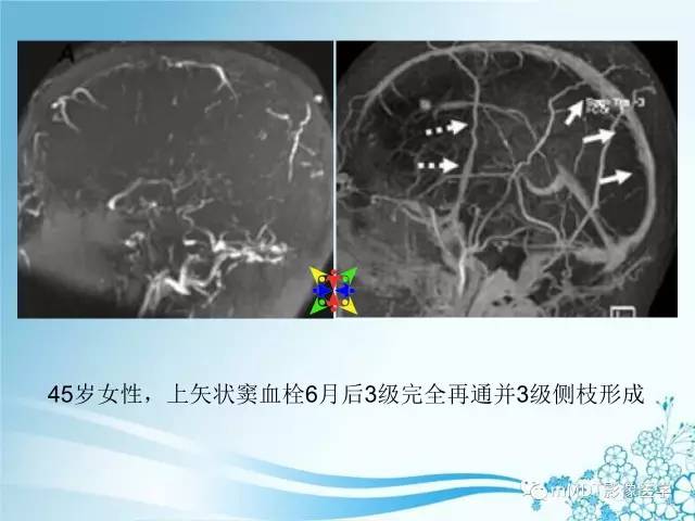 【PPT】脑静脉及静脉窦血栓影像诊断