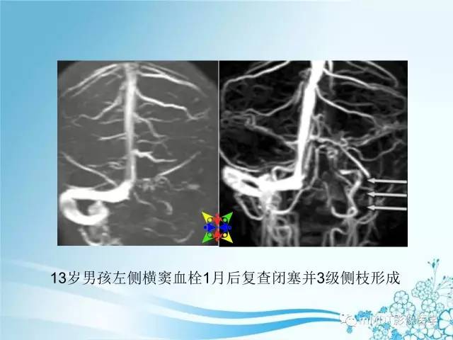 【PPT】脑静脉及静脉窦血栓影像诊断