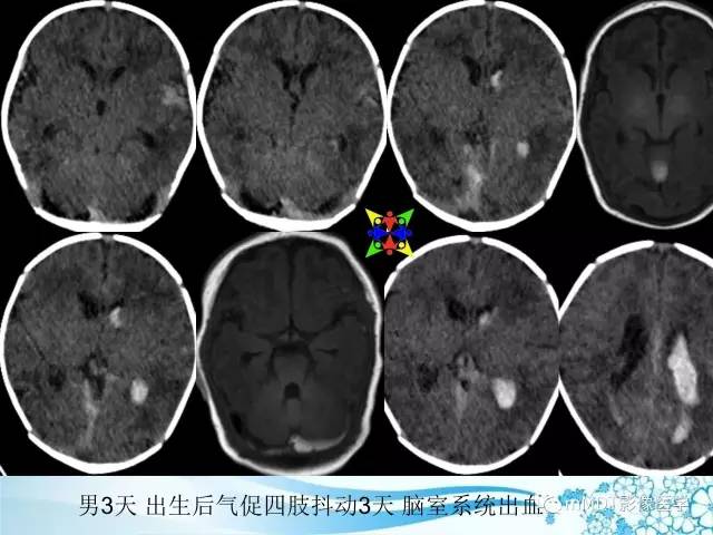 【PPT】脑静脉及静脉窦血栓影像诊断