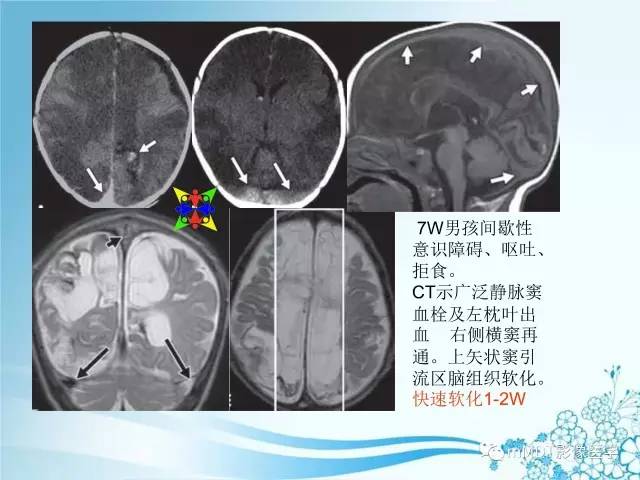【PPT】脑静脉及静脉窦血栓影像诊断