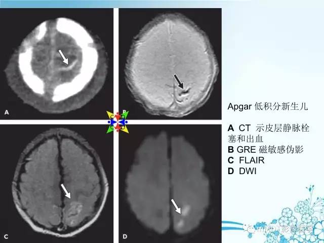 【PPT】脑静脉及静脉窦血栓影像诊断