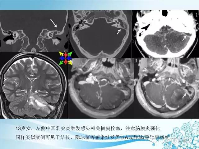【PPT】脑静脉及静脉窦血栓影像诊断