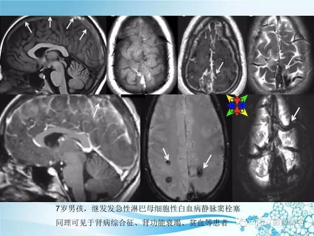 【PPT】脑静脉及静脉窦血栓影像诊断