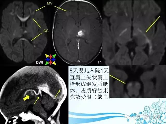 【PPT】脑静脉及静脉窦血栓影像诊断