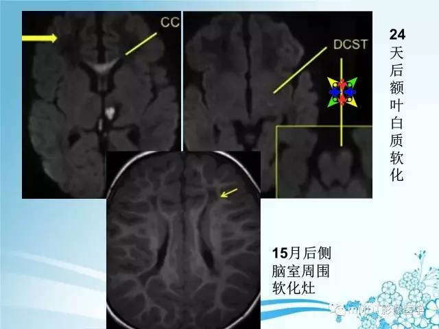 【PPT】脑静脉及静脉窦血栓影像诊断