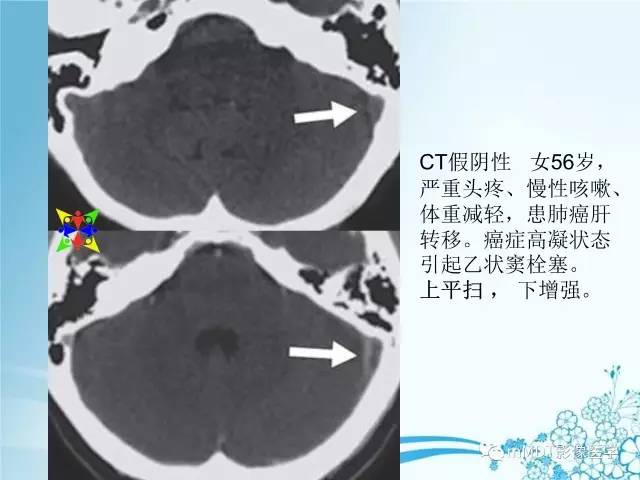【PPT】脑静脉及静脉窦血栓影像诊断