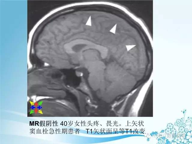 【PPT】脑静脉及静脉窦血栓影像诊断