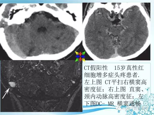 【PPT】脑静脉及静脉窦血栓影像诊断