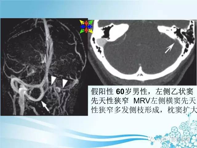 【PPT】脑静脉及静脉窦血栓影像诊断