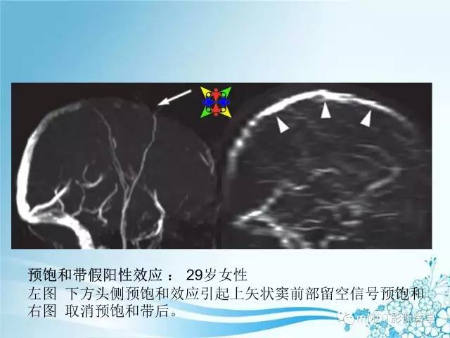 【PPT】脑静脉及静脉窦血栓影像诊断