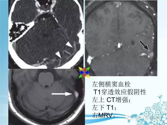 【PPT】脑静脉及静脉窦血栓影像诊断