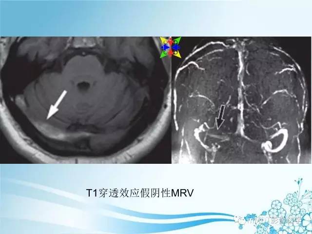 【PPT】脑静脉及静脉窦血栓影像诊断