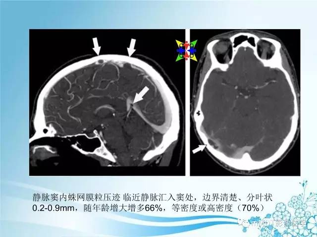 【PPT】脑静脉及静脉窦血栓影像诊断