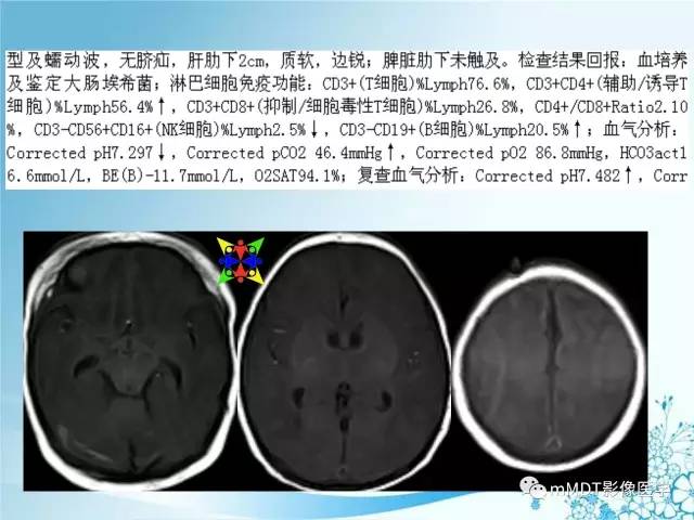 【PPT】脑静脉及静脉窦血栓影像诊断
