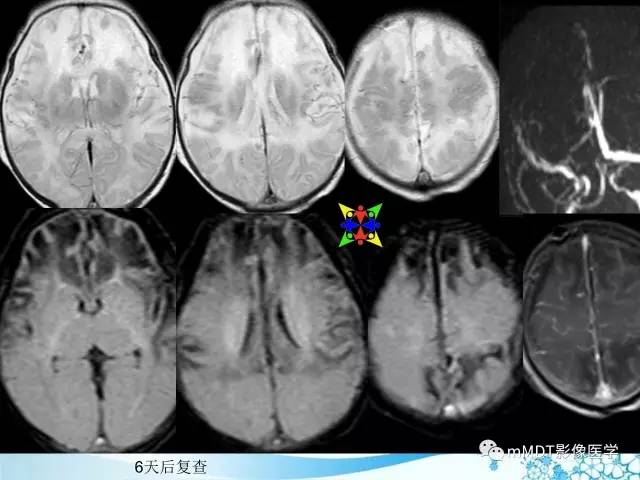 【PPT】脑静脉及静脉窦血栓影像诊断